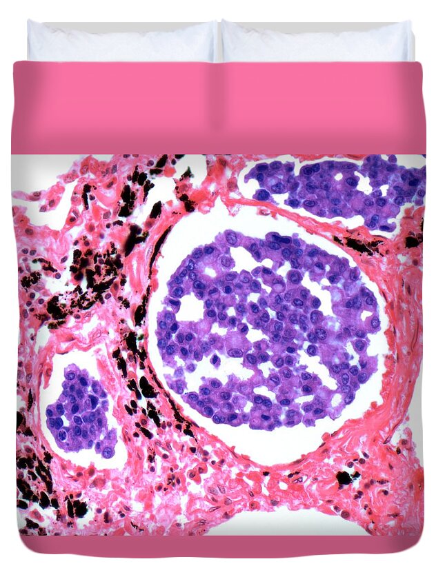 Metastasis Duvet Cover featuring the digital art Secondary Lung Cancer, Light Micrograph by Steve Gschmeissner