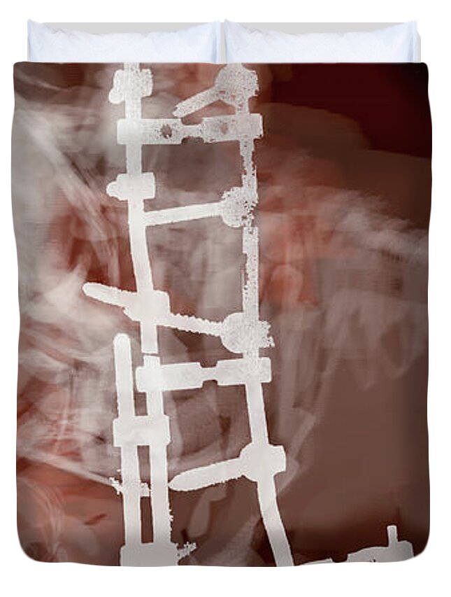 #spinalprosthesis Duvet Cover featuring the digital art Spinal Prosthesis, Study 7 by Veronica Huacuja