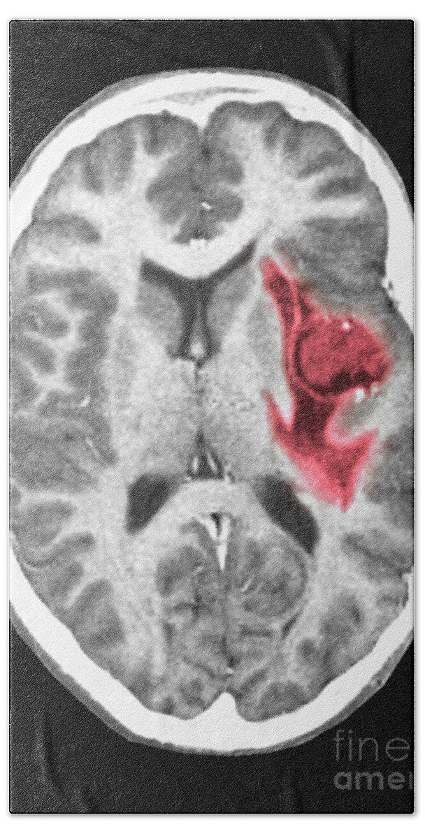 Radiology Bath Towel featuring the photograph Glioma Brain Tumor #1 by Scott Camazine