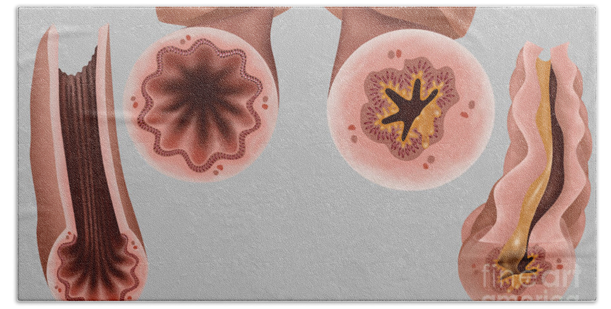 Science Bath Towel featuring the photograph Asthma Pathology by Gwen Shockey