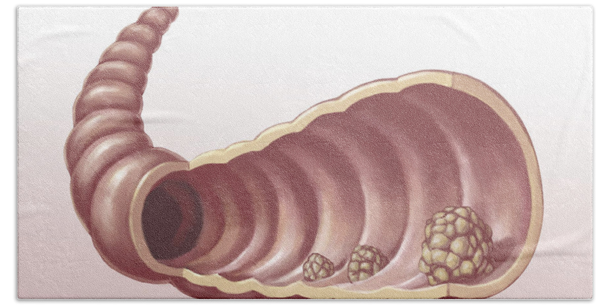 Digestive System Bath Towel featuring the photograph Intestinal Polyps, Illustration by Spencer Sutton