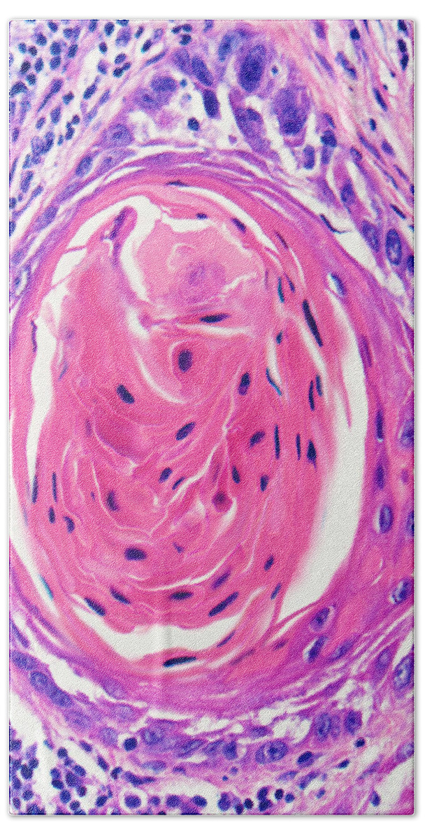 Light Micrograph Hand Towel featuring the photograph Squamous Cell Carcinoma, Keratin Pearl by Garry DeLong