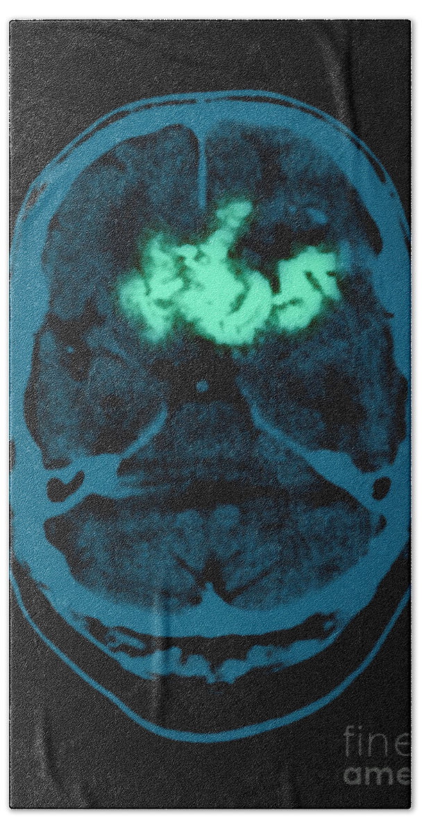 Ct Brain Tumor Bath Towel featuring the photograph Oligodendroglioma #1 by Medical Body Scans