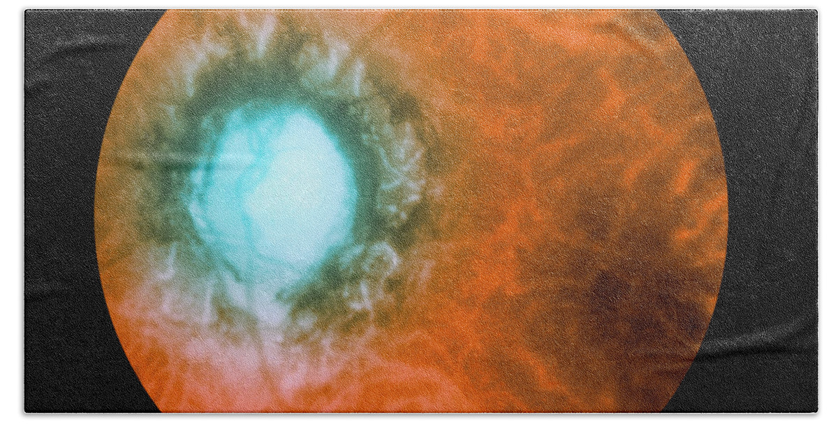 Bacteria Bath Towel featuring the photograph Retina Infected By Syphilis #1 by Science Source