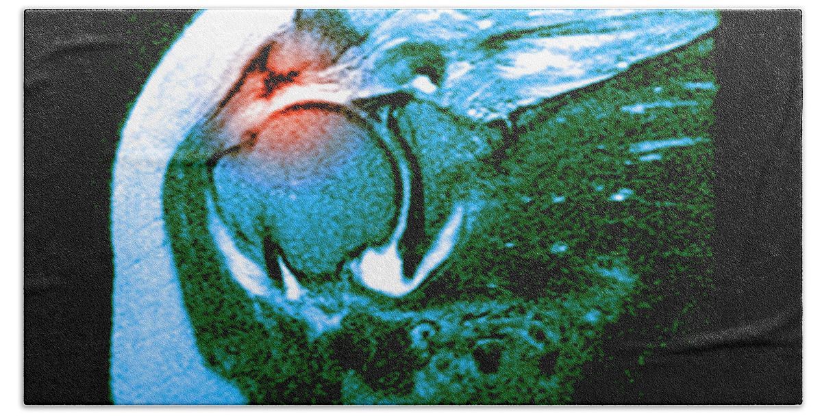 Magnetic Resonance Imaging Bath Towel featuring the photograph Rotator Cuff Tear #2 by Medical Body Scans