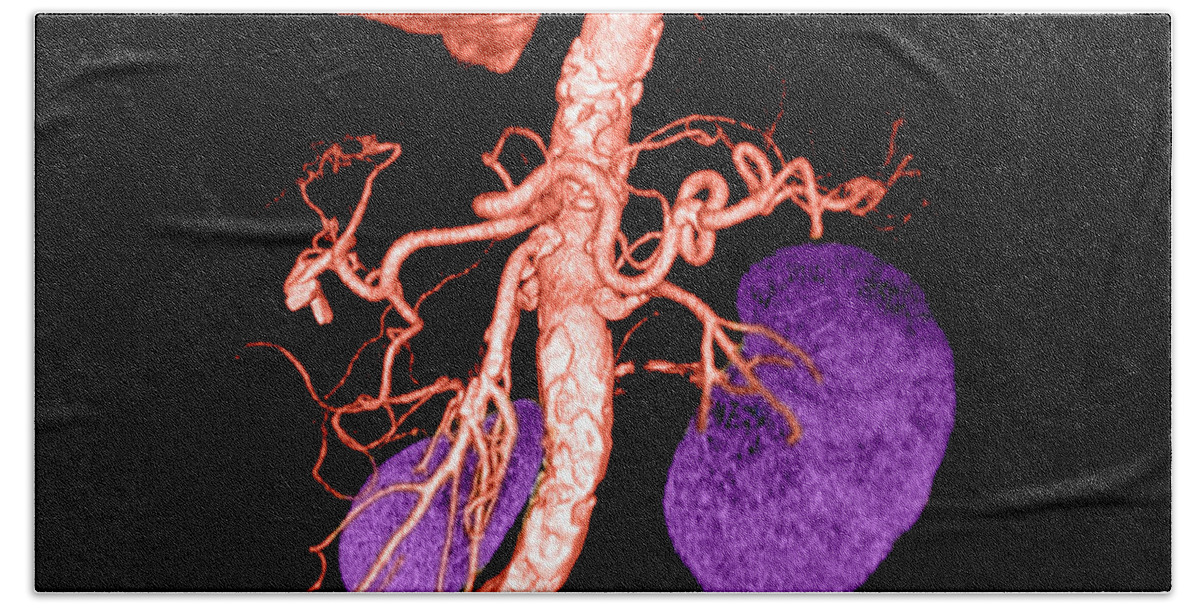 3 Dimensional Bath Towel featuring the photograph Abdominal Aorta #8 by Medical Body Scans