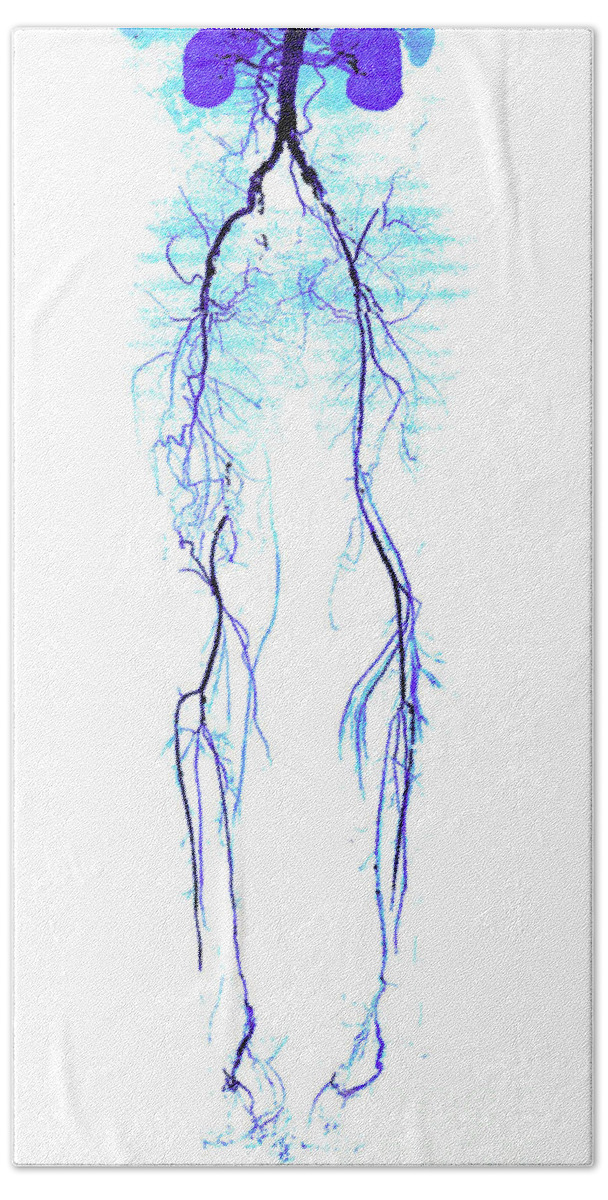 Legs Bath Towel featuring the photograph Atherosclerosis, Ct Angiogram #2 by Living Art Enterprises