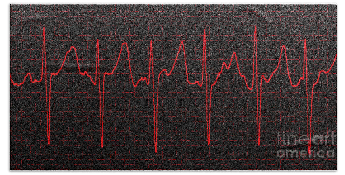 Atrial Fibrillation Bath Towel featuring the photograph Atrial Fibrillation #3 by Science Source