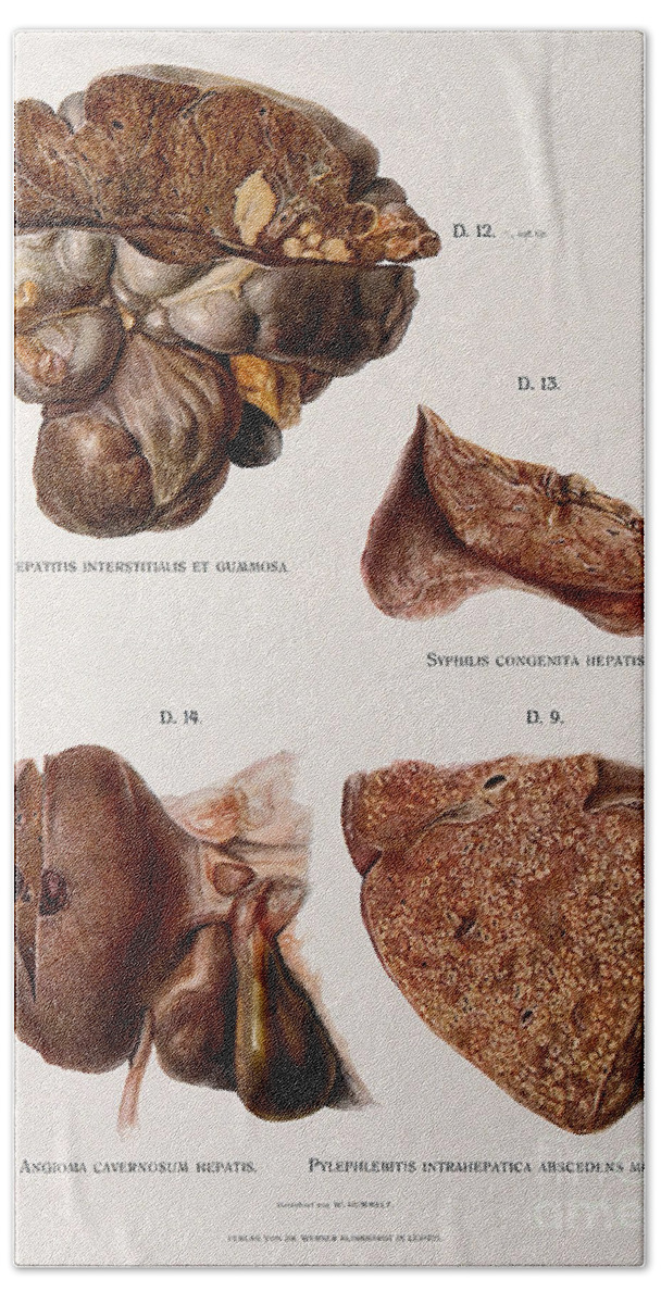 Historic Bath Towel featuring the photograph Livers, Disease Comparison by Wellcome Images