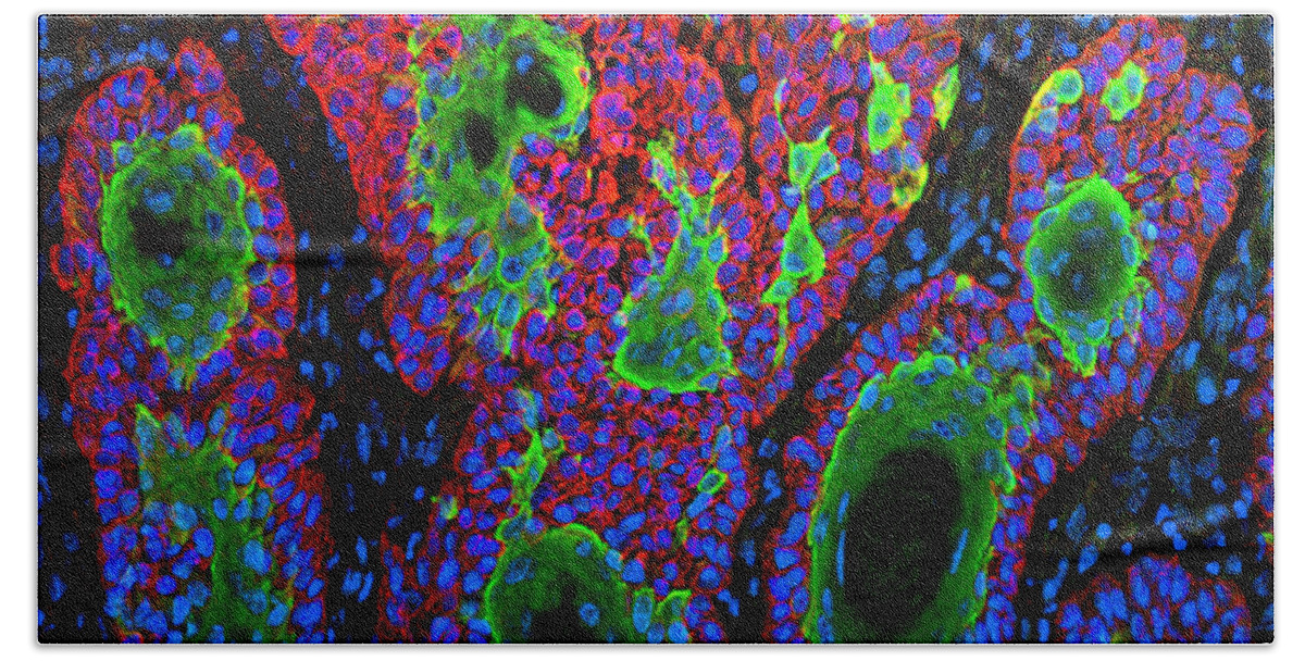 Science Bath Towel featuring the photograph Squamous Cell Carcinoma, Fm by Science Source
