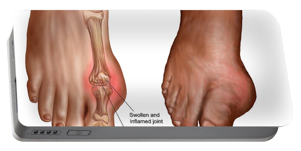 Anatomy Of A Swollen Foot Portable Battery Charger by Stocktrek Images -  Fine Art America