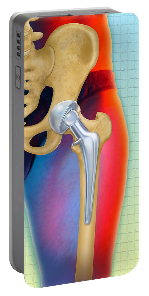 Art Portable Battery Charger featuring the photograph Prosthetic Hip Replacement by Chris Bjornberg