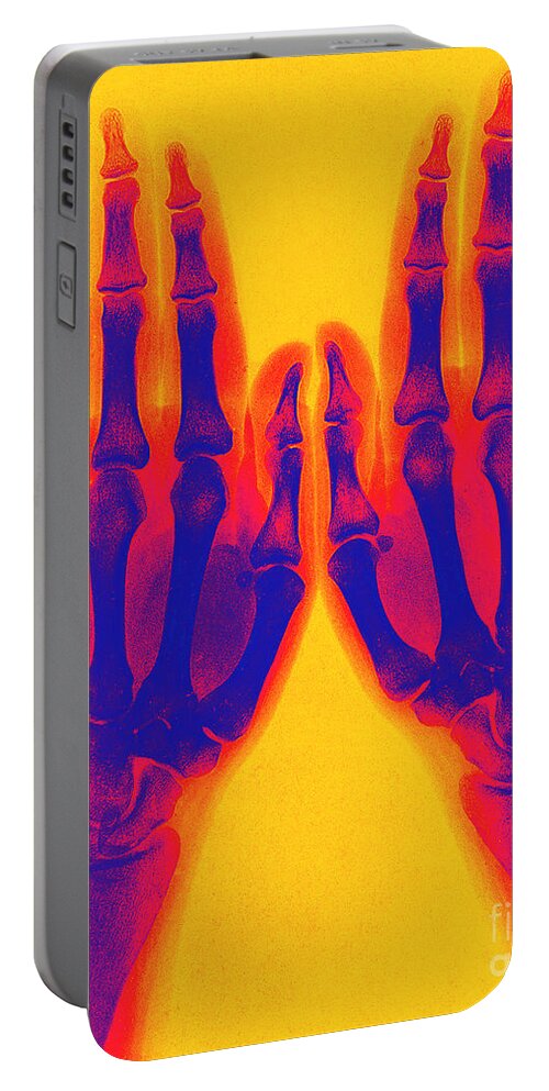 Historic Portable Battery Charger featuring the photograph X-ray Of Two Normal Hands 1896 #3 by Science Source