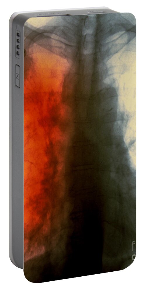 Scan Portable Battery Charger featuring the photograph Lung Cancer X-ray #2 by Scott Camazine