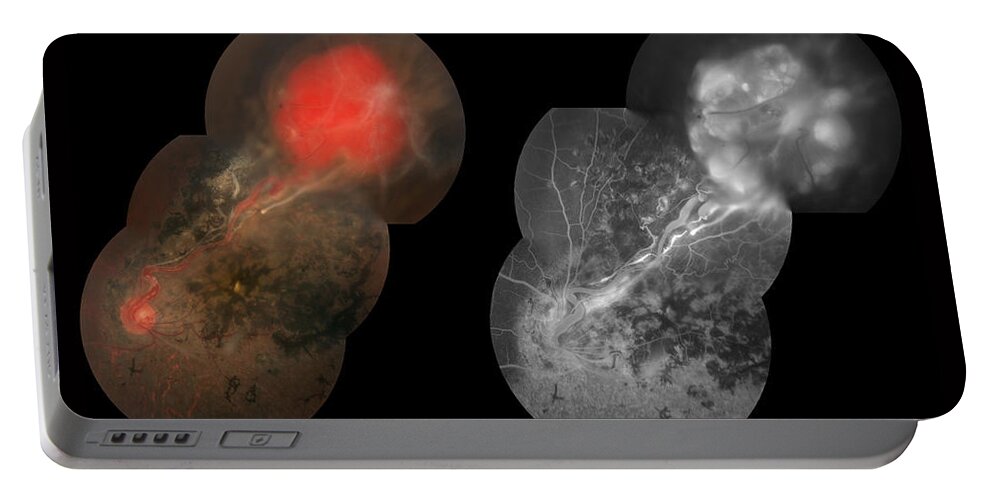 Abnormal Portable Battery Charger featuring the photograph Capillary Hemangioma, Ophthalmic #4 by Paul Whitten