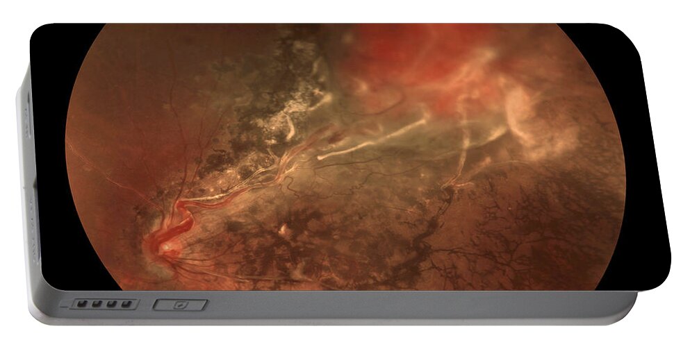 Abnormal Portable Battery Charger featuring the photograph Capillary Hemangioma, Ophthalmic by Paul Whitten