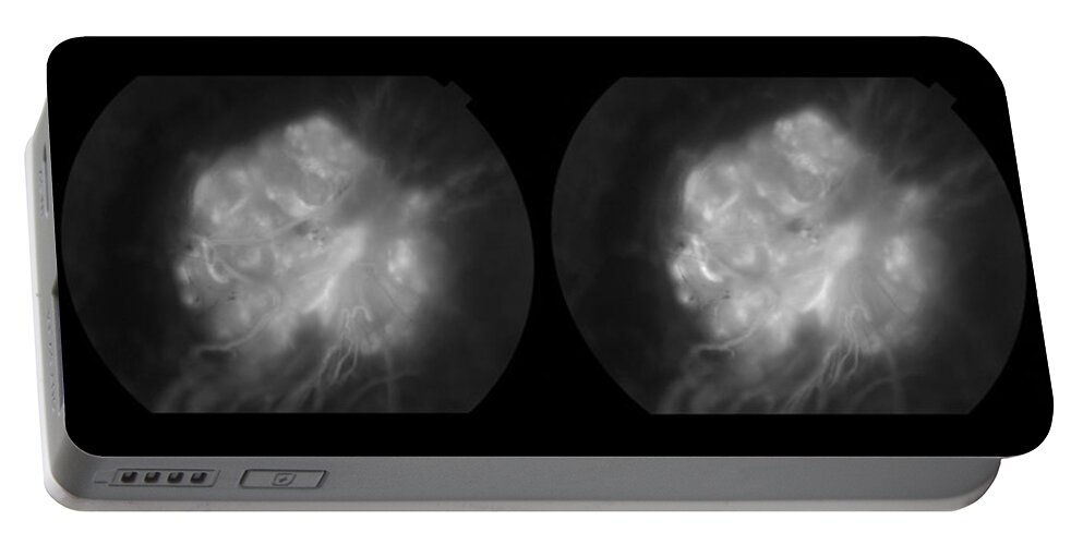 Abnormal Portable Battery Charger featuring the photograph Capillary Hemangioma Stereo Image by Paul Whitten