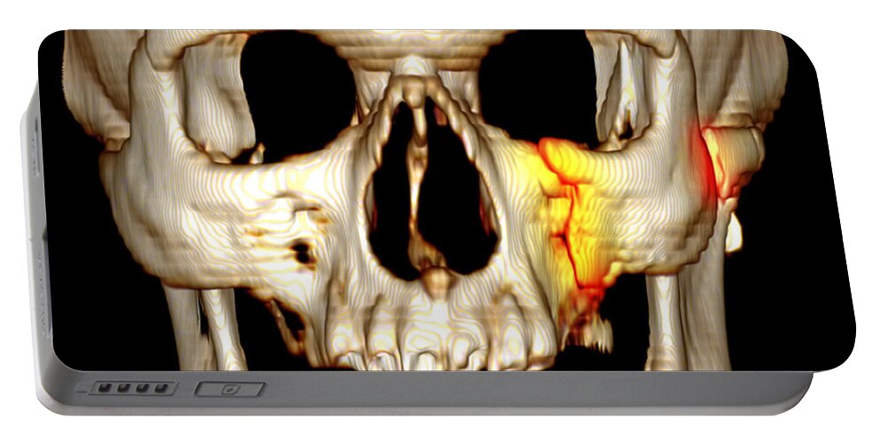 Scan Portable Battery Charger featuring the photograph Facial Fractures, Ct Scan by Scott Camazine