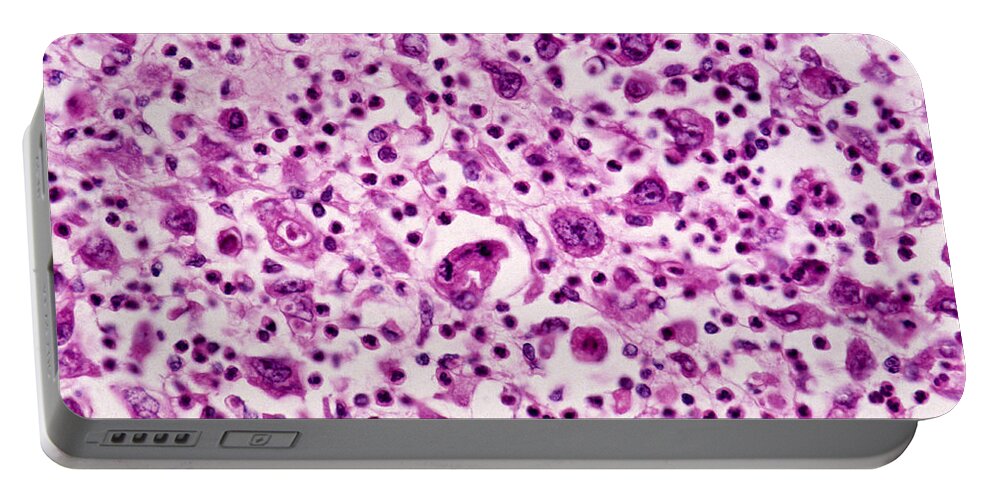 Abnormal Portable Battery Charger featuring the photograph Giant-cell Carcinoma Of The Lung, Lm by Michael Abbey