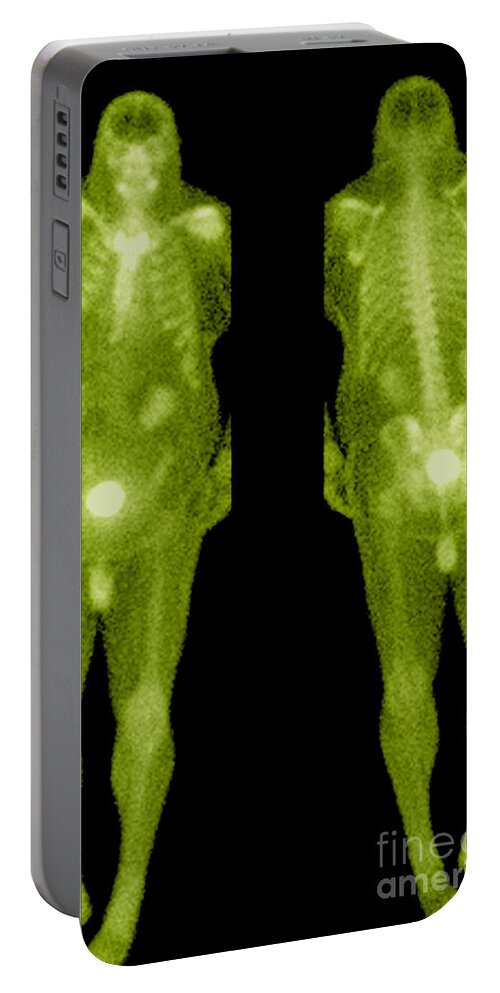 Obese Portable Battery Charger featuring the photograph Bone Scan #10 by Medical Body Scans