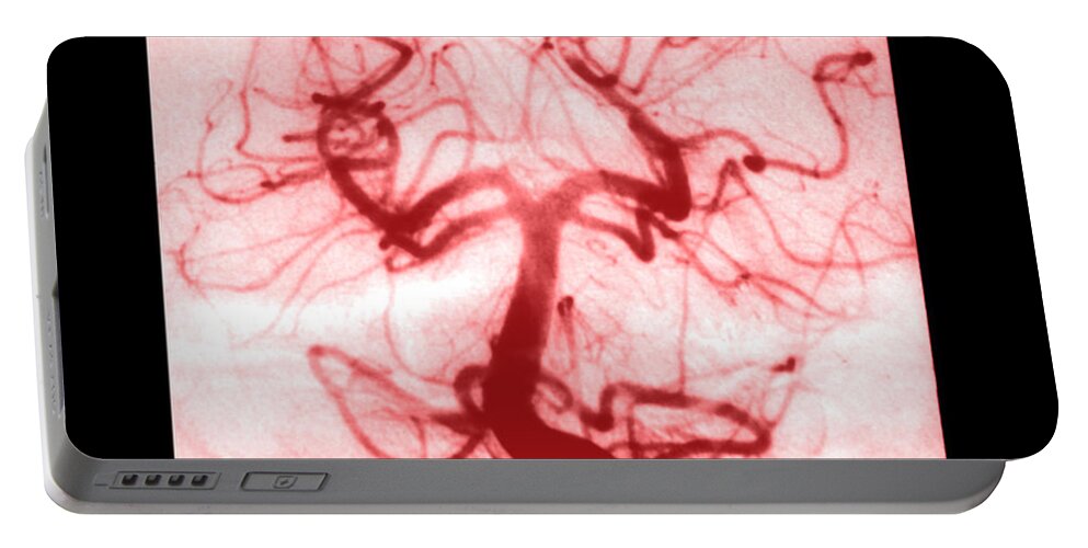 Abnormal Cerebral Angiogram Portable Battery Charger featuring the photograph Angiogram Of Embolus In Cerebral Artery #2 by Medical Body Scans