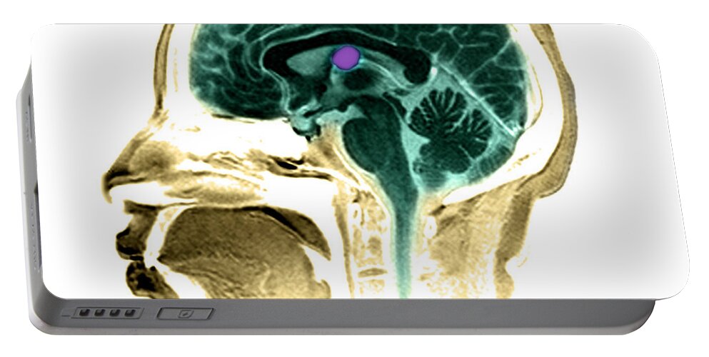 Anatomical Portable Battery Charger featuring the photograph Mri Colloid Cyst Of Third Ventricle #2 by Medical Body Scans