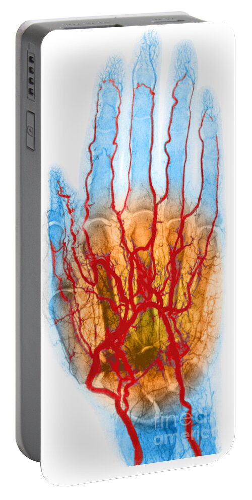 Angiogram Portable Battery Charger featuring the photograph Hand Arteriogram #3 by Science Source