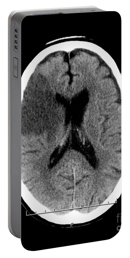 Ct Scan Portable Battery Charger featuring the photograph Ct Of Stroke #4 by Medical Body Scans