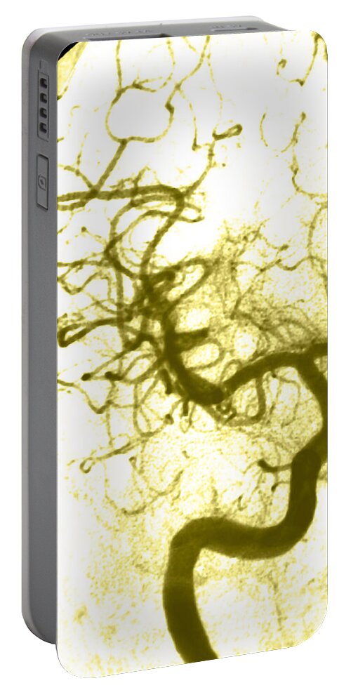 Angiogram Portable Battery Charger featuring the photograph Cerebral Angiogram #7 by Medical Body Scans