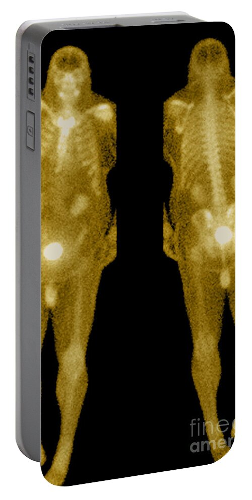 Obese Portable Battery Charger featuring the photograph Bone Scan by Medical Body Scans