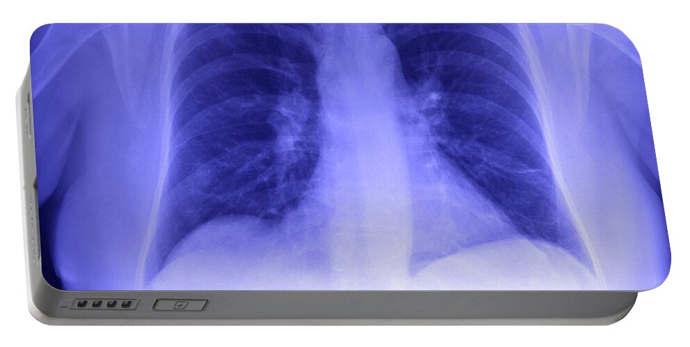 Xray Portable Battery Charger featuring the photograph Chest X-ray by Ted Kinsman