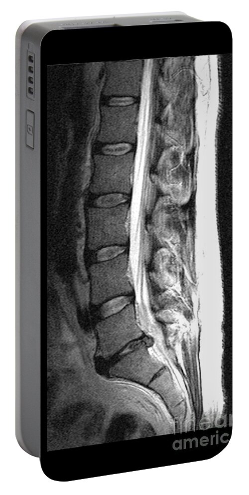 Mri Portable Battery Charger featuring the photograph Herniated Disc by Medical Body Scans