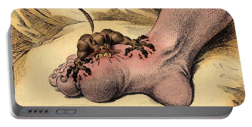 18th Century Portable Battery Charger featuring the photograph The Gout by Science Source