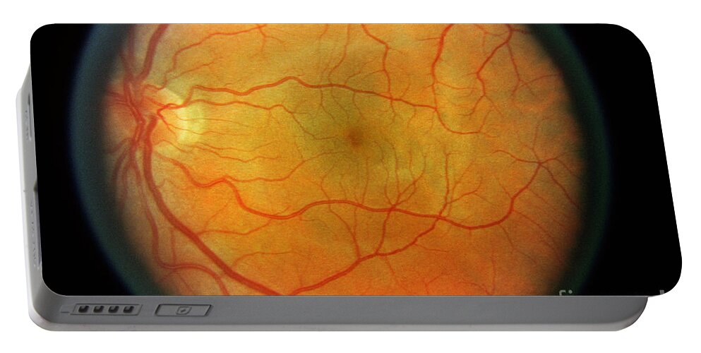 Blood Vessels Portable Battery Charger featuring the photograph Normal Retina #2 by Science Source