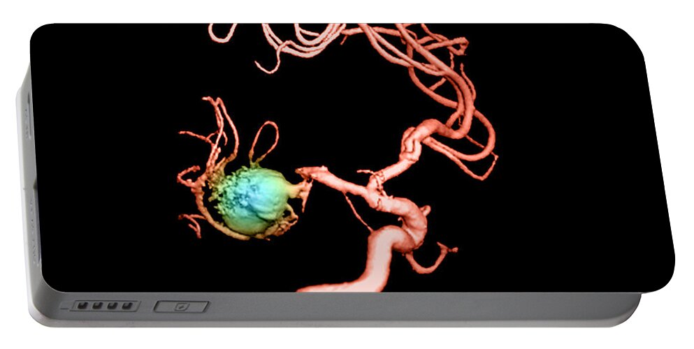 3-d Imagery Portable Battery Charger featuring the photograph Aneurysm In The Human Brain #3 by Medical Body Scans