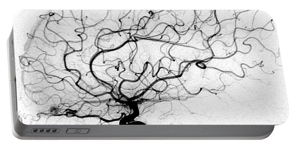 Cerebral Angiogram Portable Battery Charger featuring the photograph Dural Arterial Venous Fistula, Angiogram by Living Art Enterprises