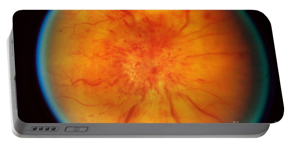 Blood Vessels Portable Battery Charger featuring the photograph Retinal Papilledema by Science Source