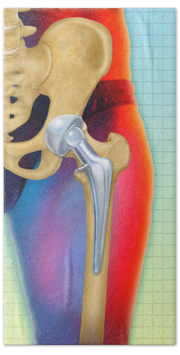 Art Beach Towel featuring the photograph Prosthetic Hip Replacement by Chris Bjornberg