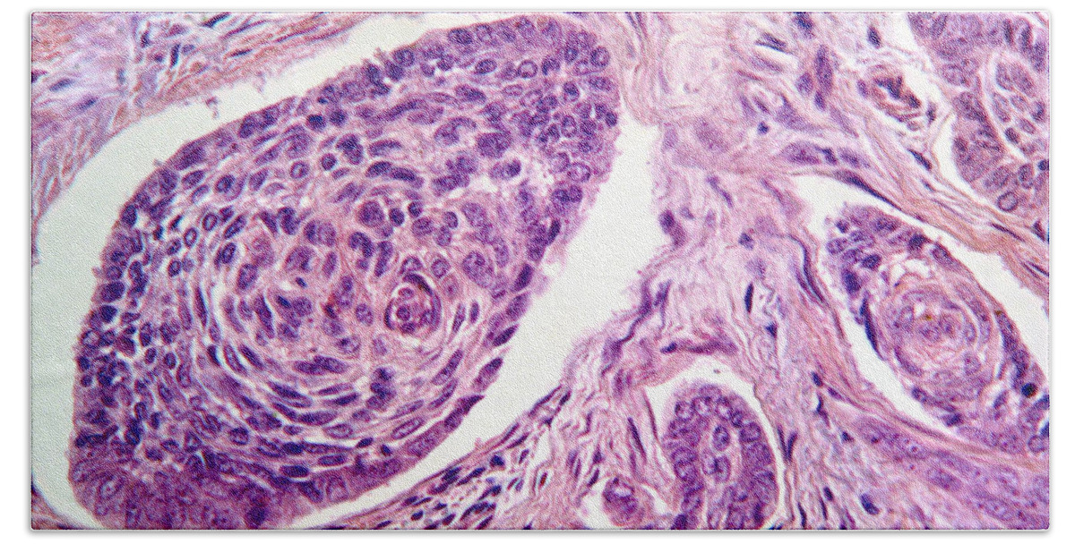 Carcinoma Beach Towel featuring the photograph Basal Cell Carcinoma by Garry DeLong