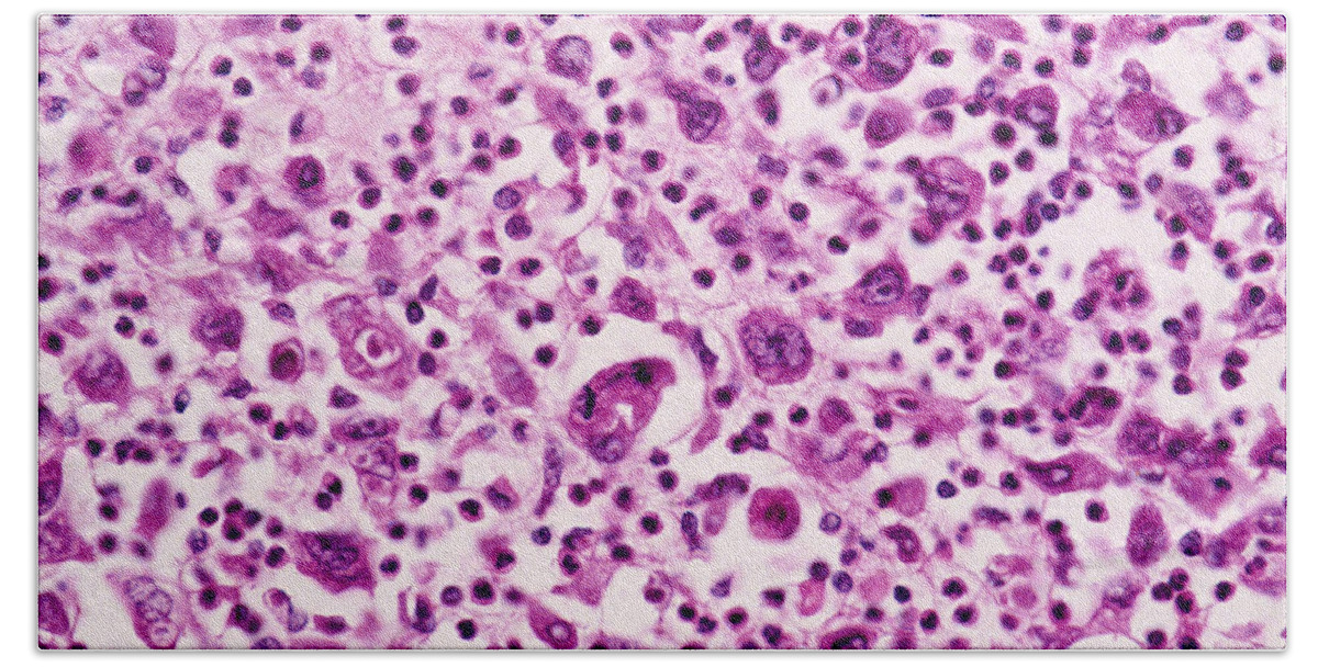 Abnormal Beach Towel featuring the photograph Giant-cell Carcinoma Of The Lung, Lm by Michael Abbey