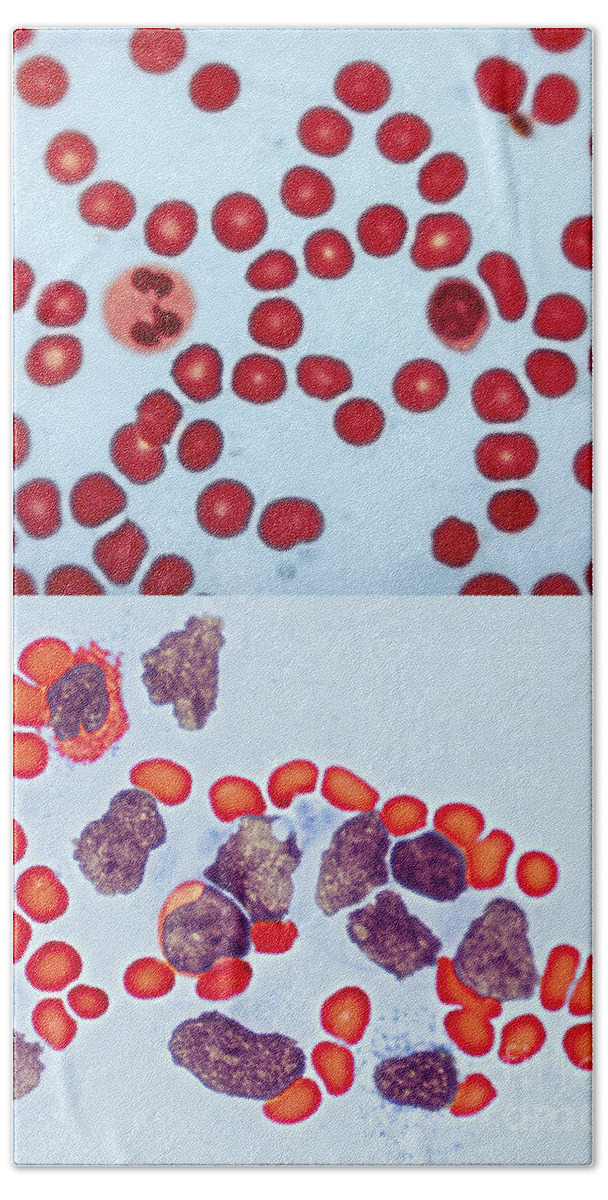 Blood Cell Beach Towel featuring the photograph Healthy Leukemia Blood Comparison by Spencer Sutton