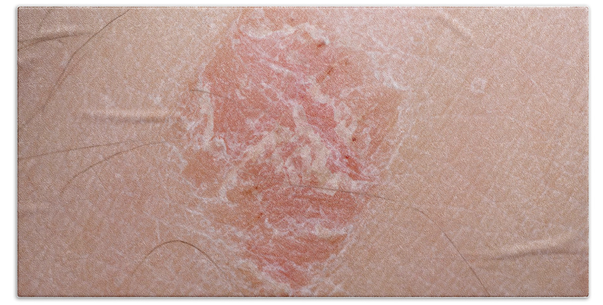 Auto Immune Beach Towel featuring the photograph Plaque Psoriasis On Leg by Martin Shields