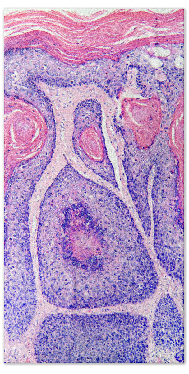 Squamous In Situ Beach Towel featuring the photograph Skin Cancer, Bowens Disease, Lm by Garry DeLong