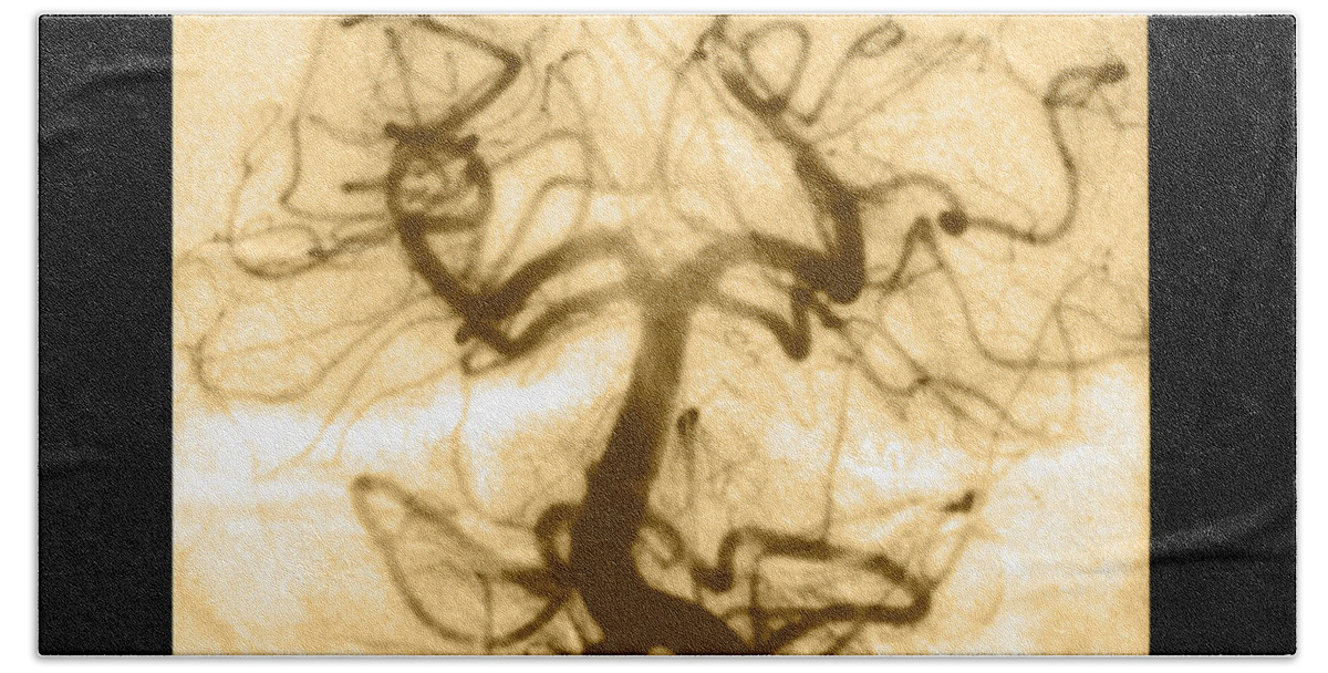 Abnormal Cerebral Angiogram Beach Towel featuring the photograph Angiogram Of Embolus In Cerebral Artery #1 by Medical Body Scans