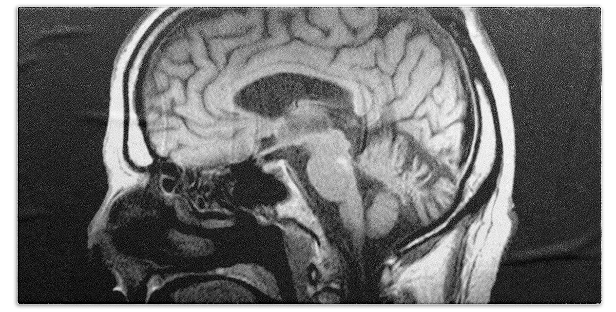 Mri Of Brain Beach Towel featuring the photograph Mri Of Alcoholism Related Vermian #1 by Medical Body Scans