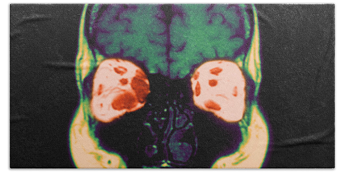 Abnormal Extra-ocular Muscle Beach Towel featuring the photograph Mri Of Graves Disease #1 by Medical Body Scans