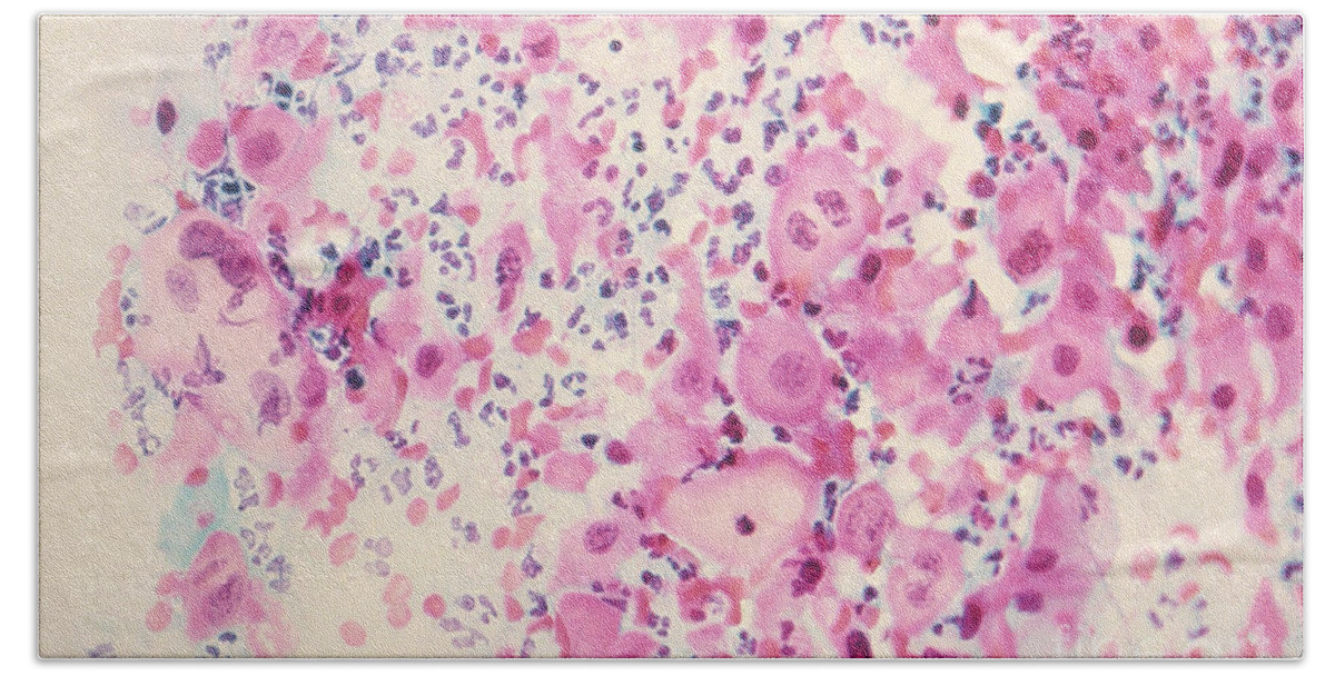 Medical Beach Towel featuring the photograph Pap Smear Cancer #3 by Science Source