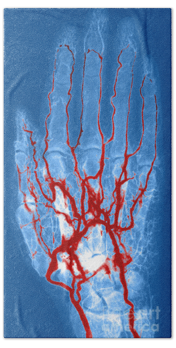 Angiogram Beach Towel featuring the photograph Hand Arteriogram #4 by Science Source
