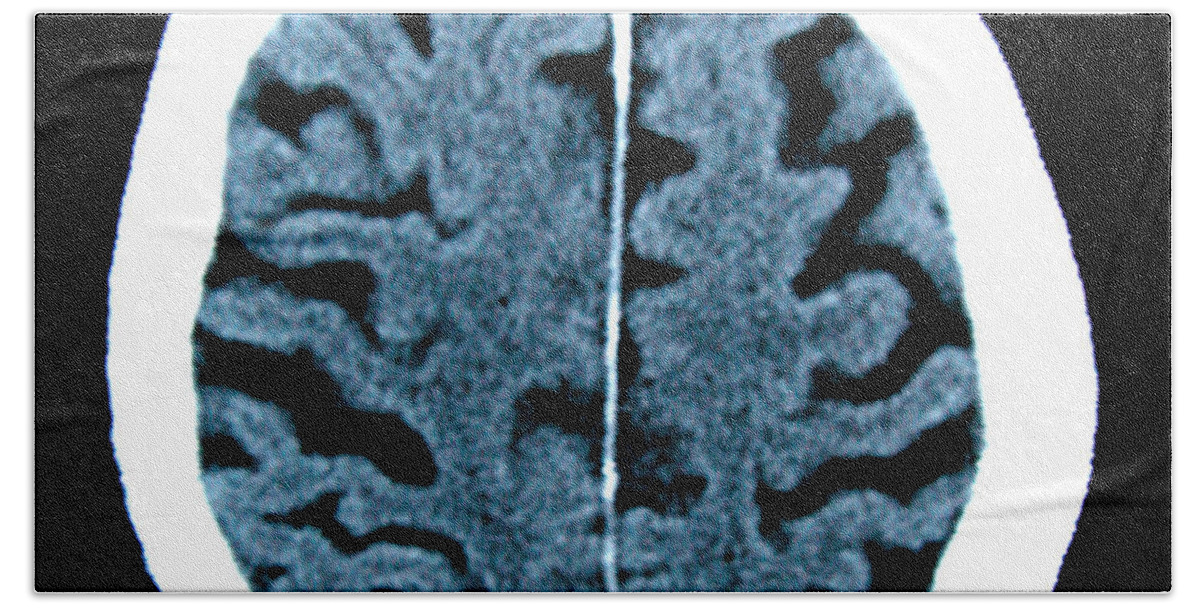 Radiology Beach Towel featuring the photograph Brain Of Alzheimers Patient, Ct Scan #1 by Scott Camazine