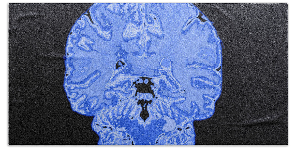 Brain Beach Towel featuring the photograph Coronal View Mri Of Normal Brain #2 by Medical Body Scans